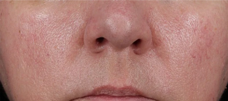 Porovnání před a po aplikaci